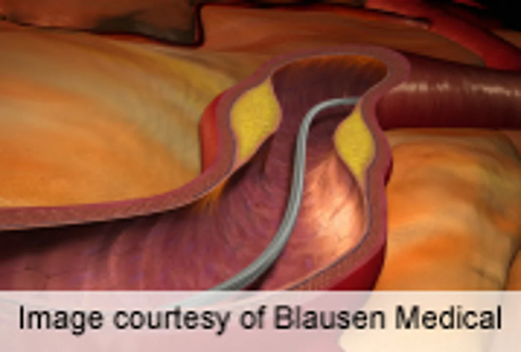 Drug-Eluting Stents Reduce Risk of Thrombosis