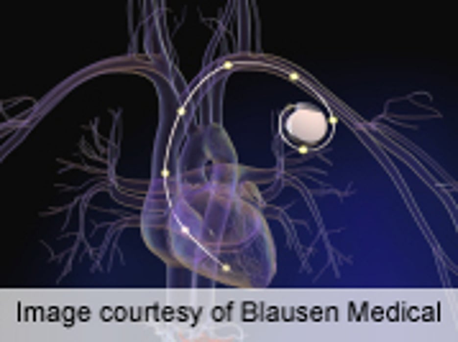 Implantable Defibrillators Cut Out-of-Hospital Cardiac Arrests