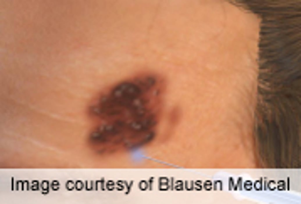 New Melanoma Drug May Extend Survival