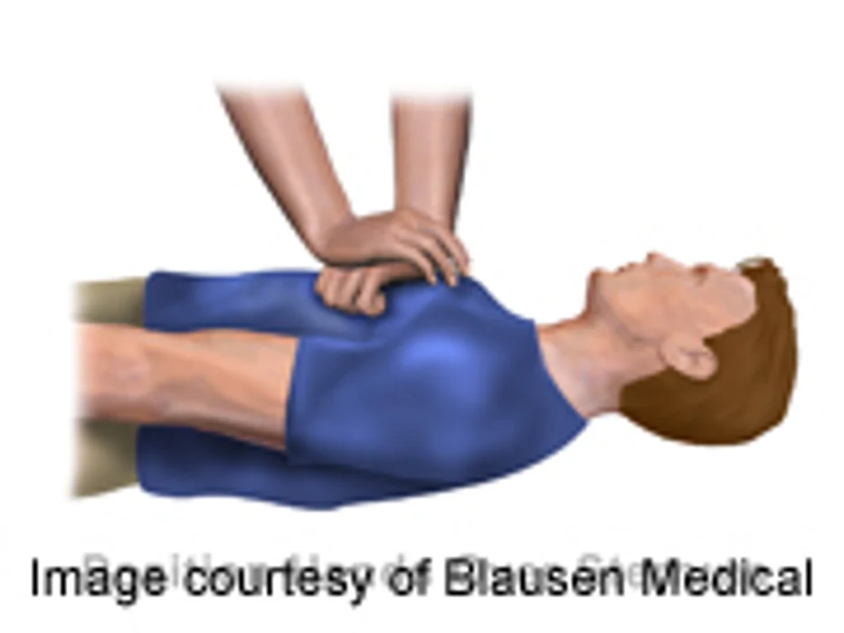 Study Supports CPR Chest Compressions for Cardiac Arrest
