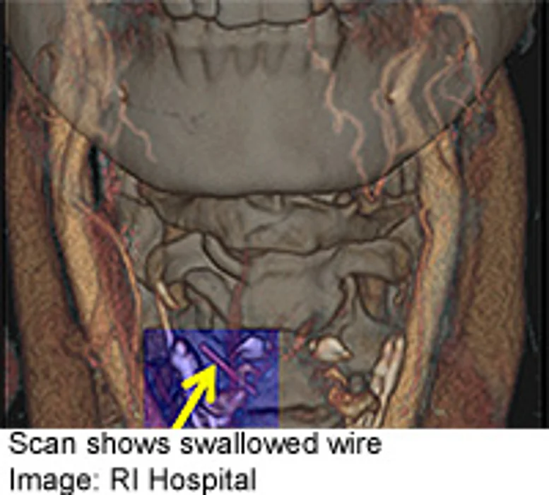 BBQ Danger: Wires From Grill Cleaners Swallowed in Food