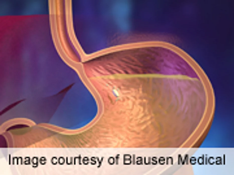 Experimental Chemo Combo for Colon Cancer Disappoints