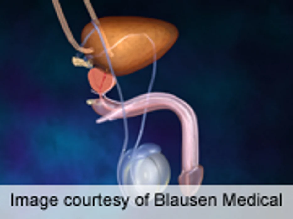 Better Analgesia From Pelvic Plexus Block in Prostate Biopsy