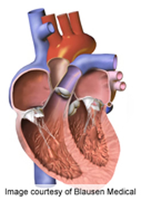 Closure of Patent Foramen Ovale Doesn't Beat Medical Tx