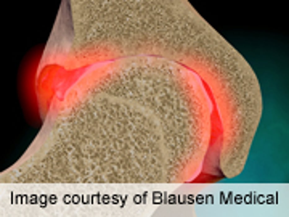 Physical Therapy No Help for Painful Hip Osteoarthritis