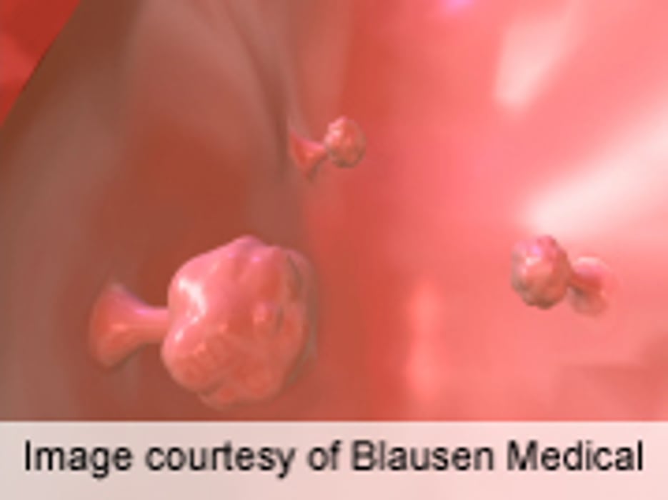 Overuse of Surveillance Colonoscopy After Resection
