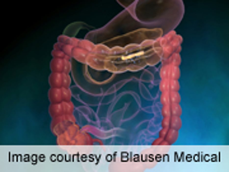 Laxative Type Might Influence Colorectal Cancer Risk