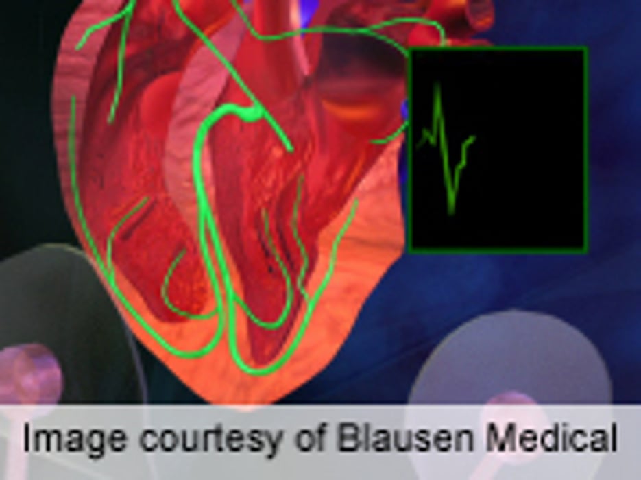 Delayed Cardioversion With A-Fib Ups Thromboembolic Risk