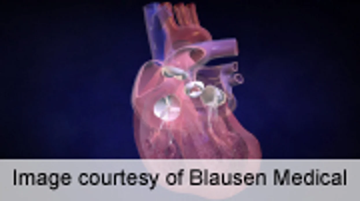 Combining Heart Valve Repair With Bypass May Be Worthwhile