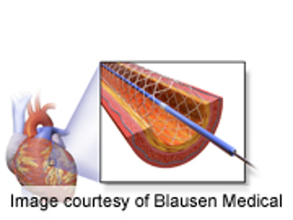No Benefit for Stent Versus Medical Therapy in Stable CAD