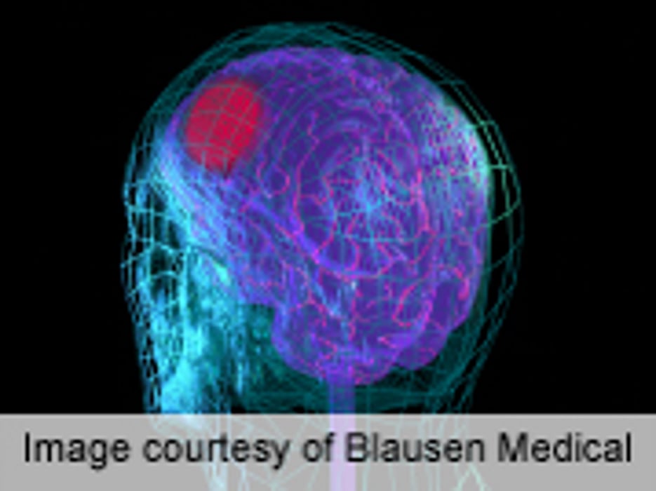 AHA/ASA Release Female-Specific Stroke Prevention Guidelines