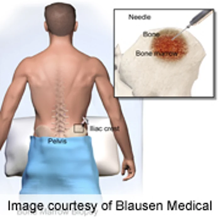 New Drug May Help Fight Rare Bone Marrow Disorder