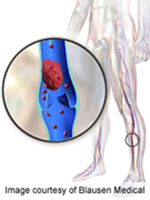 New Blood Thinner Beats Older Drug for Vein Clots: Study