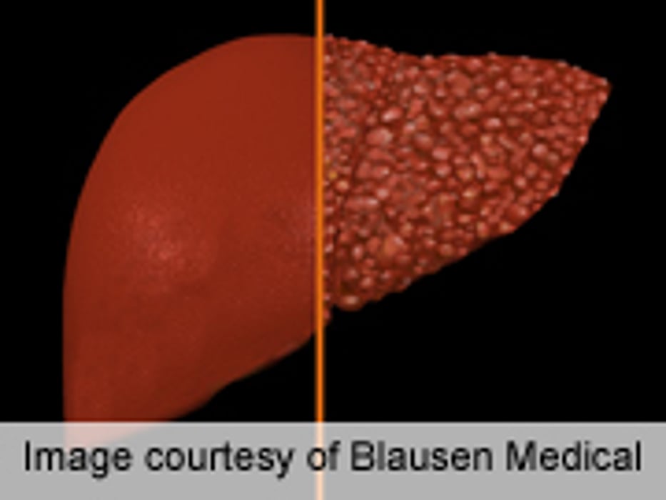 Ultrasound IDs Post-Transplant Recurrent Hep C Cirrhosis
