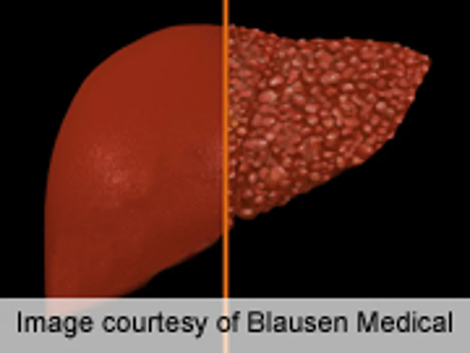 Ultrasound IDs Post-Transplant Recurrent Hep C Cirrhosis