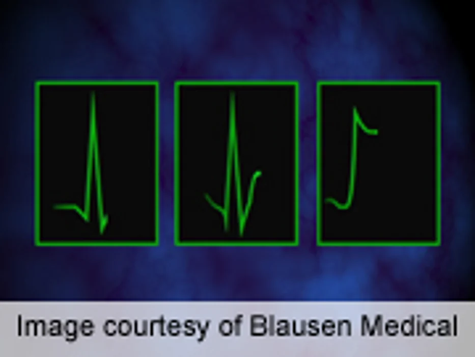 Coronary Artery Spasms Rare During Dobutamine Stress Echo