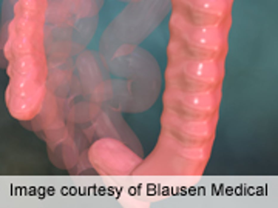 Genes May Be Key for Patients With Multiple Colon Polyps