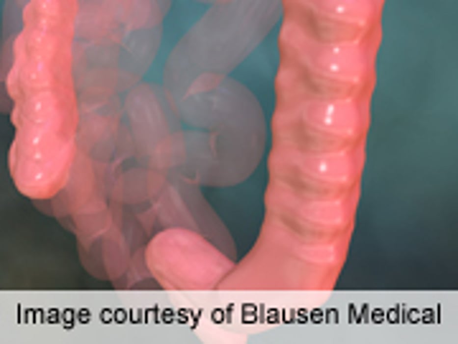 New Colon Cancer Screening Guidelines Focus on Individual Risk