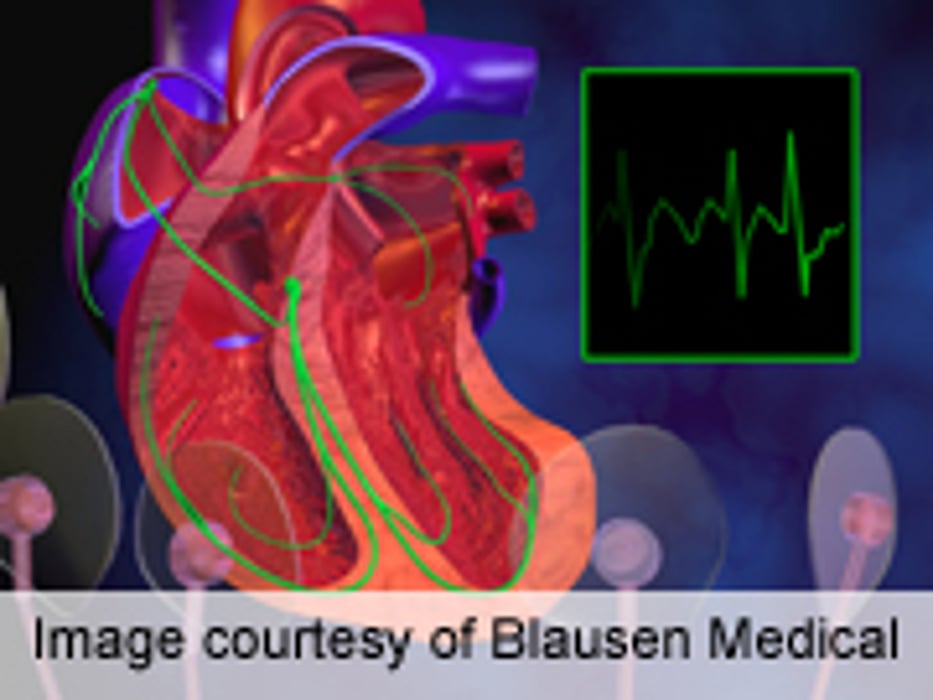 New Guidelines Issued for Management of Atrial Fibrillation