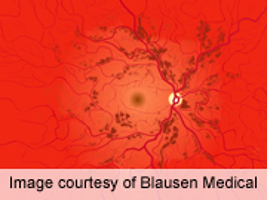Hypertension Ups Retinopathy Risk With HCV Treatment