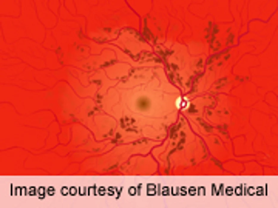 Risk Estimator ID'd for Sight-Threatening Diabetic Retinopathy