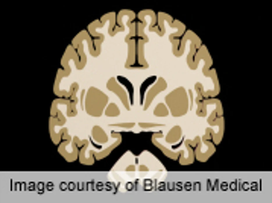 Gray Matter Abnormalities Persist After Mild Traumatic Brain Injury