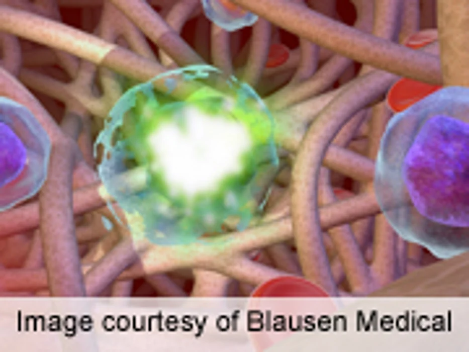ACCR: Oral Olaparib Plus Chemo Beneficial in Ovarian Cancer
