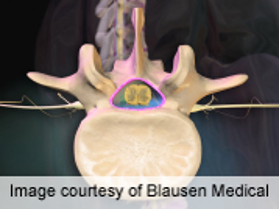 Instrumented Spinal Fusion Method Impacts Infection Rate