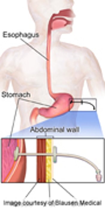 Type of Attending Doc Affects Feeding Tube Rates in Elderly
