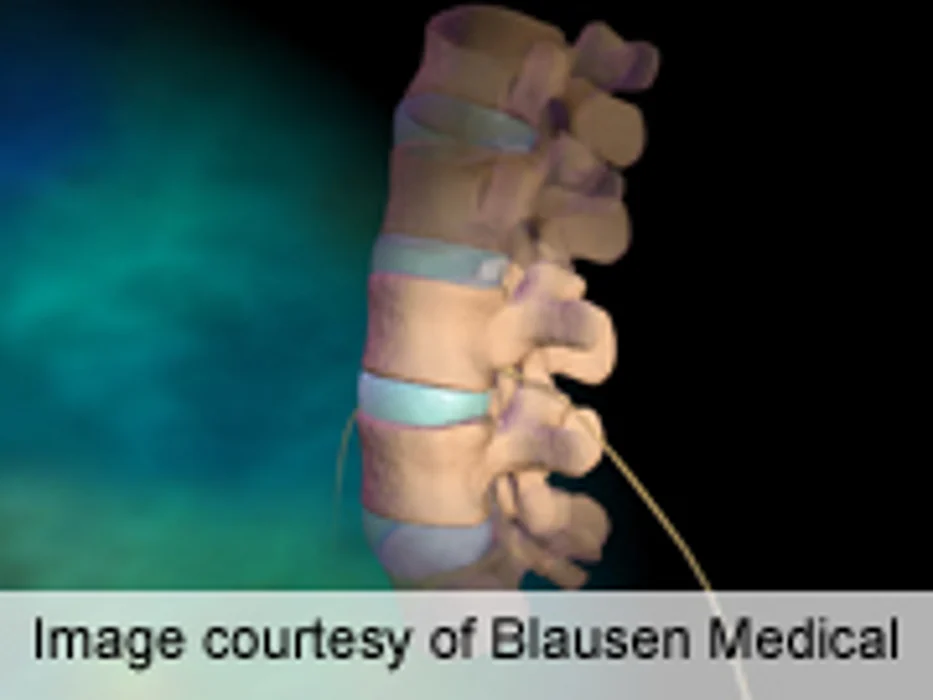 Predictors of Length of Hospital Stay After Spine Surgery ID'd
