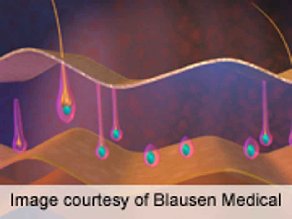 Hair Loss Pathology Identified in Pityriasis Versicolor Lesions