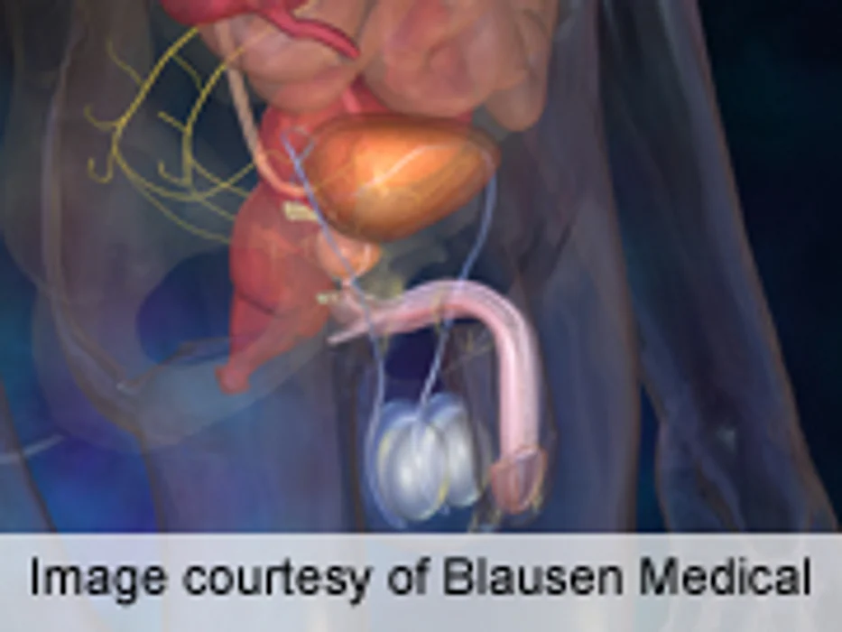 U.S. Task Force Recommends Against PSA-Based Screening