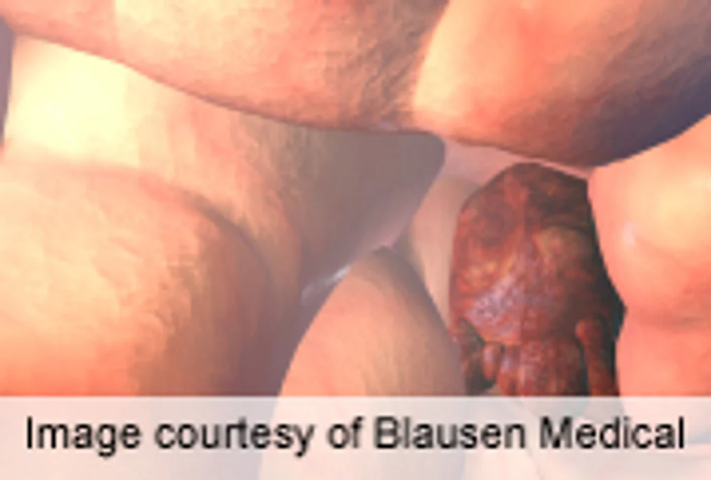 Uninsured With Brain Tumors Have Higher Post-Op Mortality