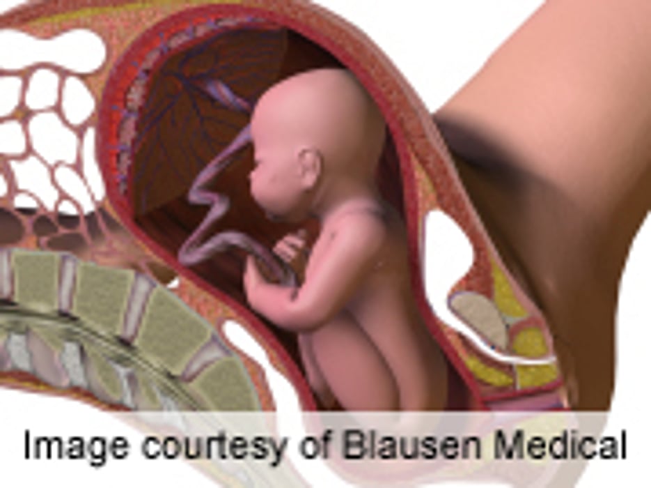No Mortality Benefit With Vertex-Status Early Preterm C-Section