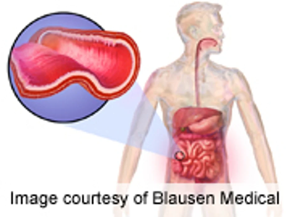 Meta-Analysis Compares Tx for Inducing Remission in Crohn's