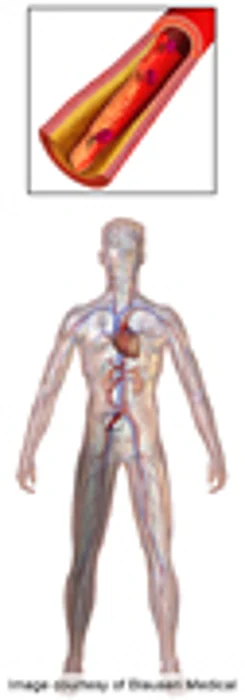 Peripheral Artery Disease on the Rise Worldwide