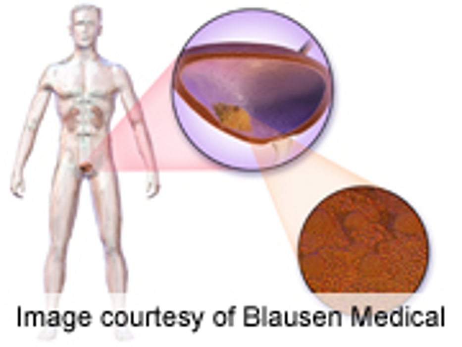 Chemo + Radiation Best for Bladder Cancer, Study Finds