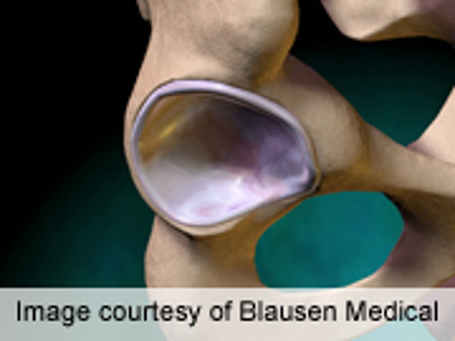 Hip Resurfacing Shows Higher Failure Rate Than Replacement