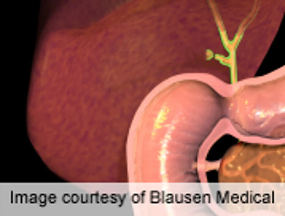 Adjuvant Therapy Shows Promise in Biliary Tract Cancer