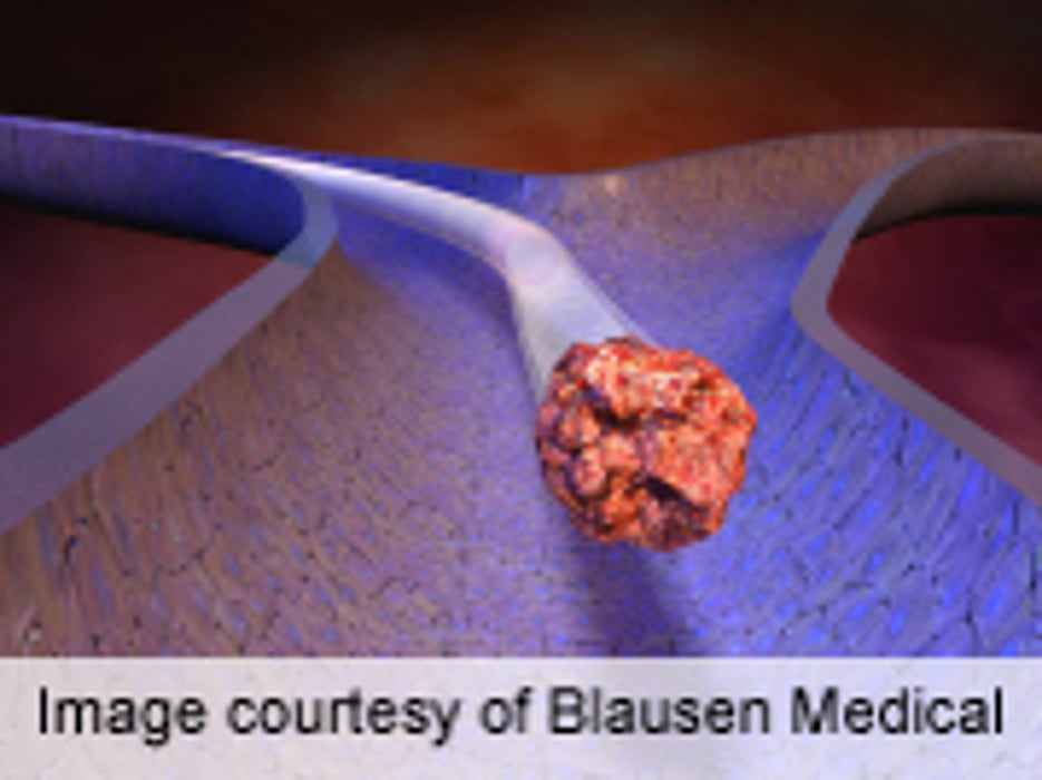 Increased VTE Risk Seen in Rheumatoid Arthritis Qualified