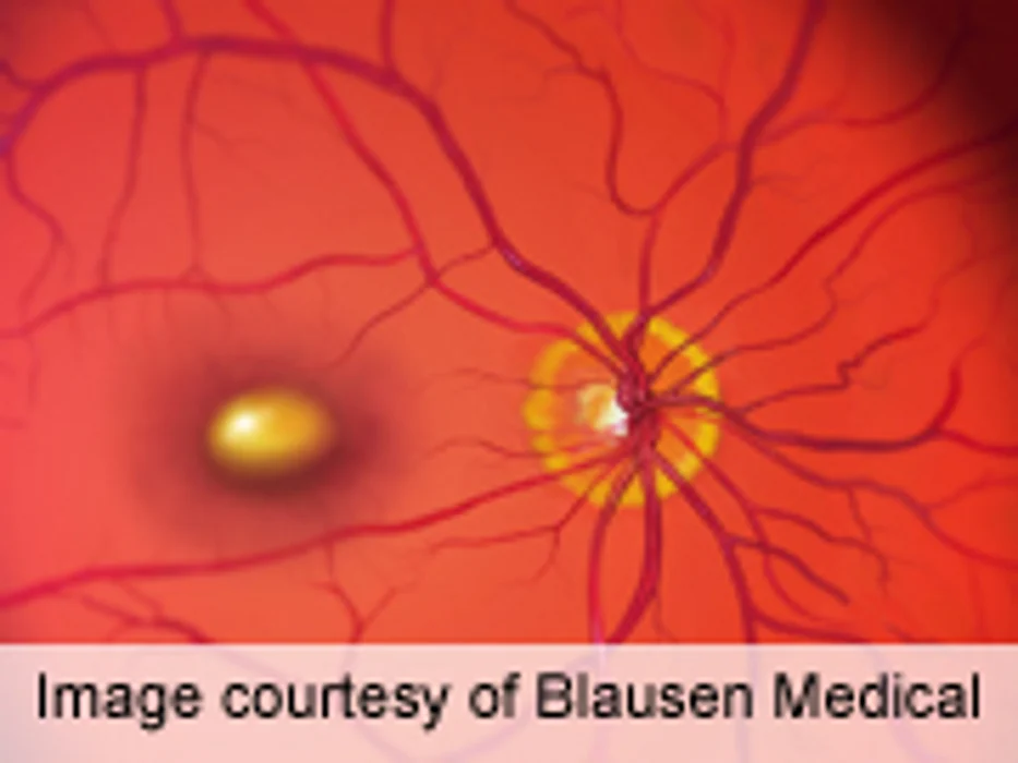 Supplement Aids Age-Related Macular Degeneration