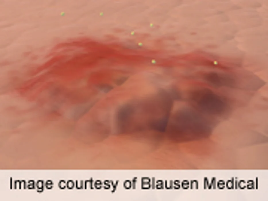 Stability of Fragrance Patch Test Preparations Examined