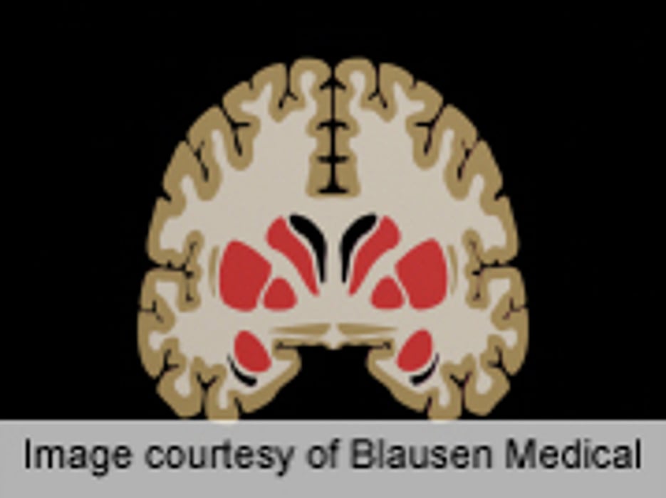 White Matter Hyperintensities Tied to Alzheimer's Disease