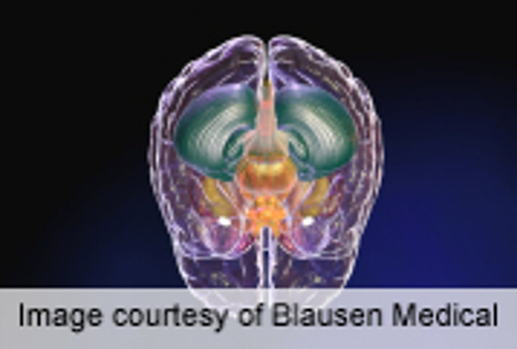 Autism Tied to Increased Connectivity in Brain Networks