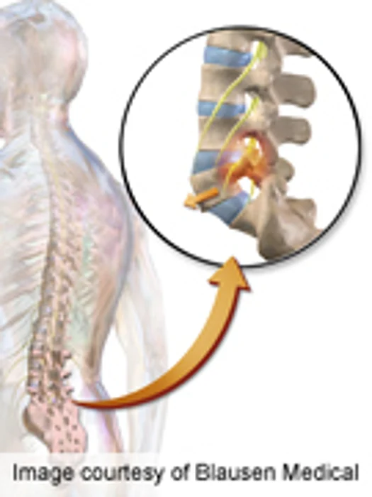 Pre-Op Pain Patterns Affect Stenosis Surgery Outcomes