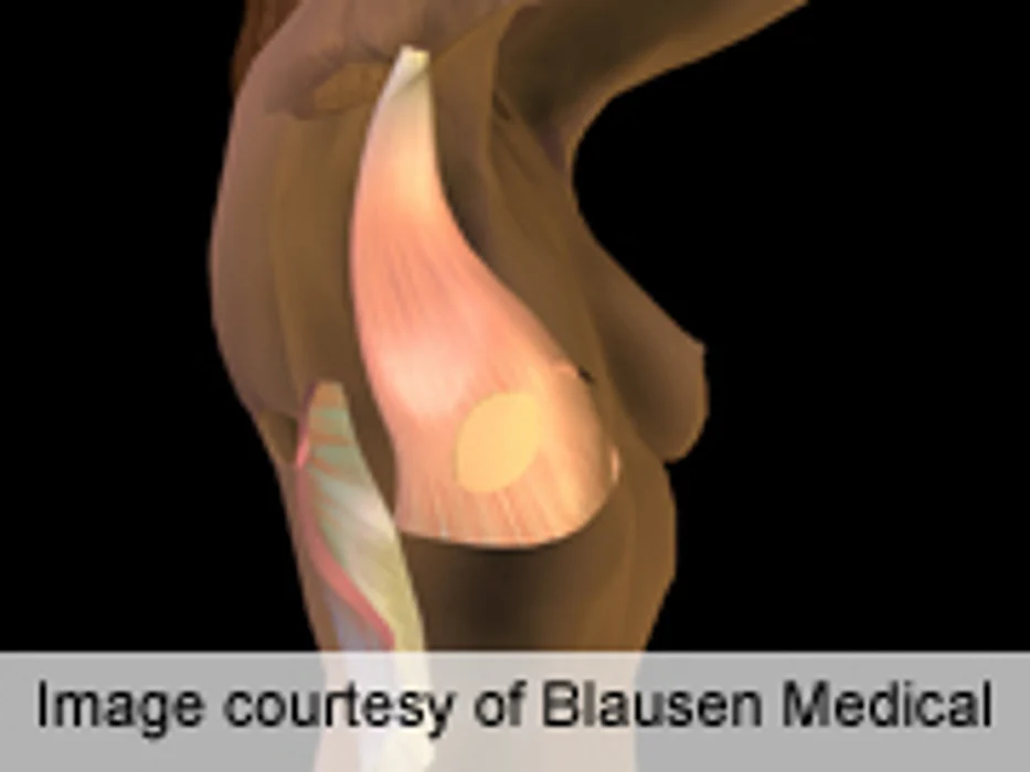 Significant Patient Satisfaction Post-Breast Reduction Surgery