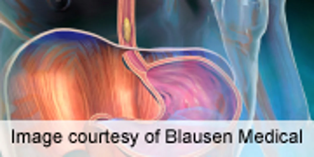 New Guidelines Urge Limiting Endoscopy for GERD