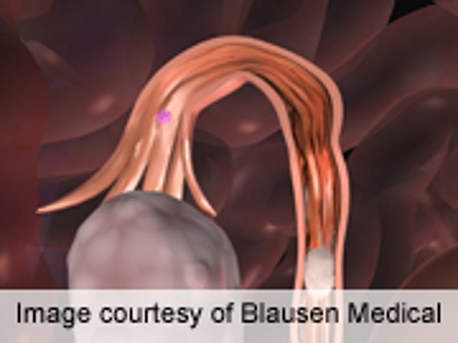 ENDO: Ovarian Stimulation Linked to Shorter Children