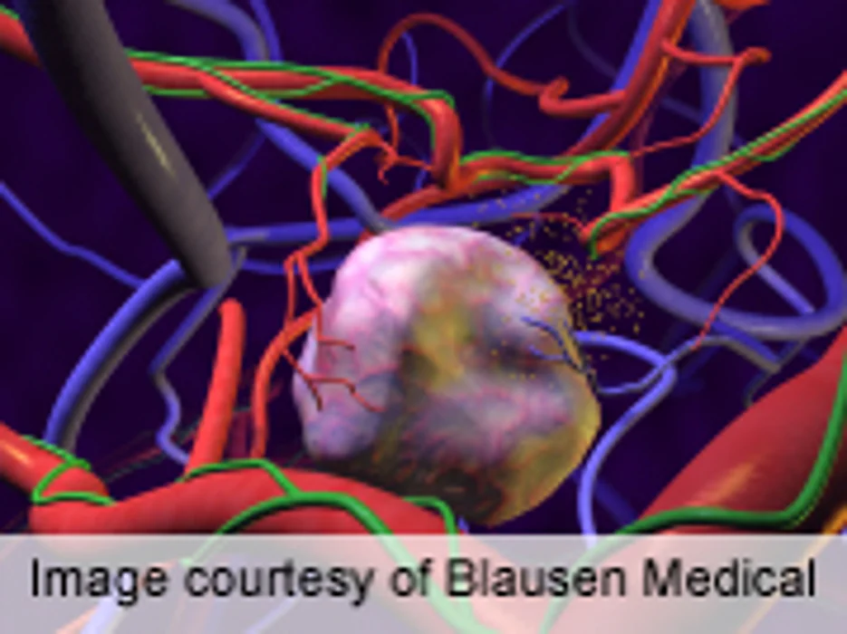 Imaging Method Can Assess Solid Tumor Aggressiveness