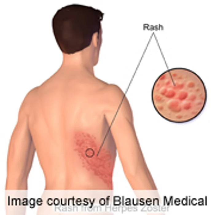 Stroke Risk Spikes Shortly After Shingles Episode: Study